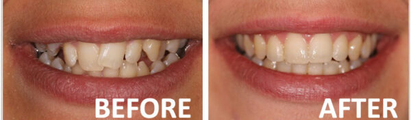 Methods of treating misaligned teeth Methods of treating misaligned teeth