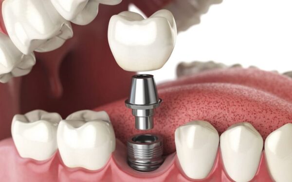 Các bước đặt implant