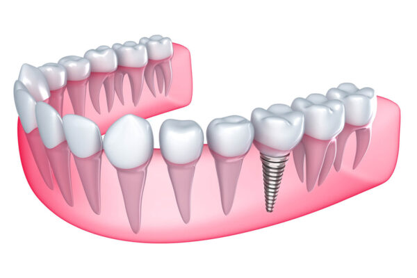 Cần chuẩn bị những gì trước khi là implantm