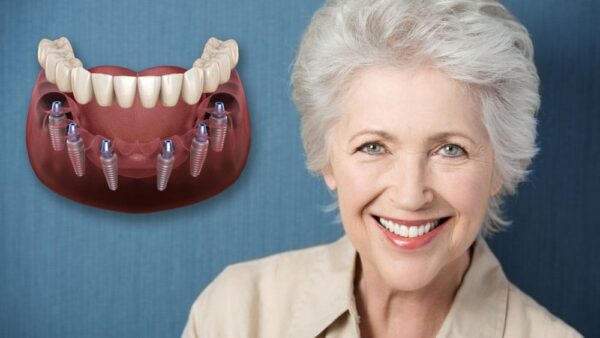 Cấy Ghép Implant All On 6 Là Gì? Những Điều Cần Biết Về Phương Pháp Này