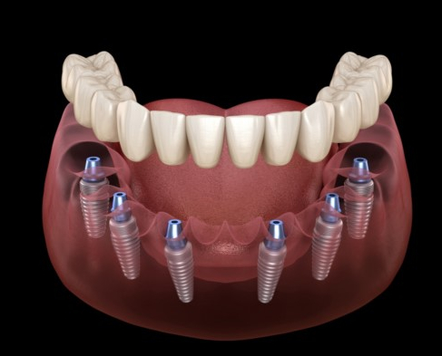 Khái niệm cấy ghép implant all on 6