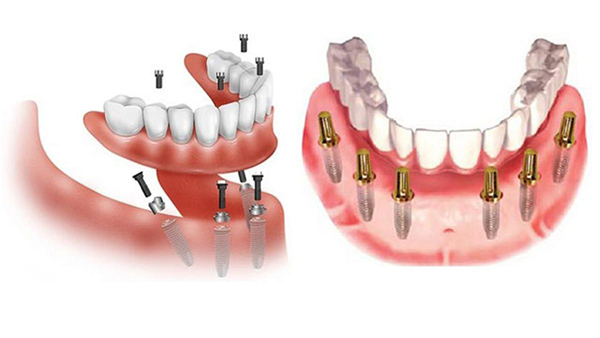 Những đối tượng nào nên và không nên cấy ghép implant all on 6