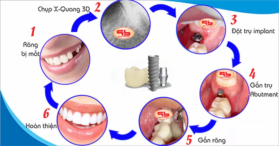 Quy trình cấy ghép implant chuẩn xác