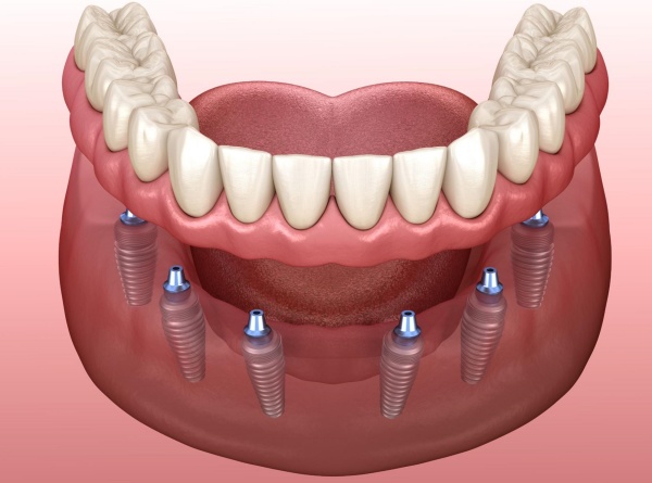 Quy trình diễn ra phương pháp cấy ghép implant all on 6