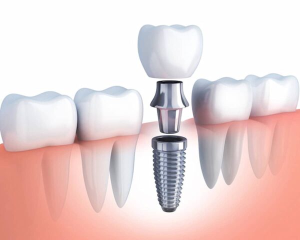 Trồng Răng Implant Có Đau Không? Một Vài Lưu Ý Sau Khi Đã Trồng Răng Iplant