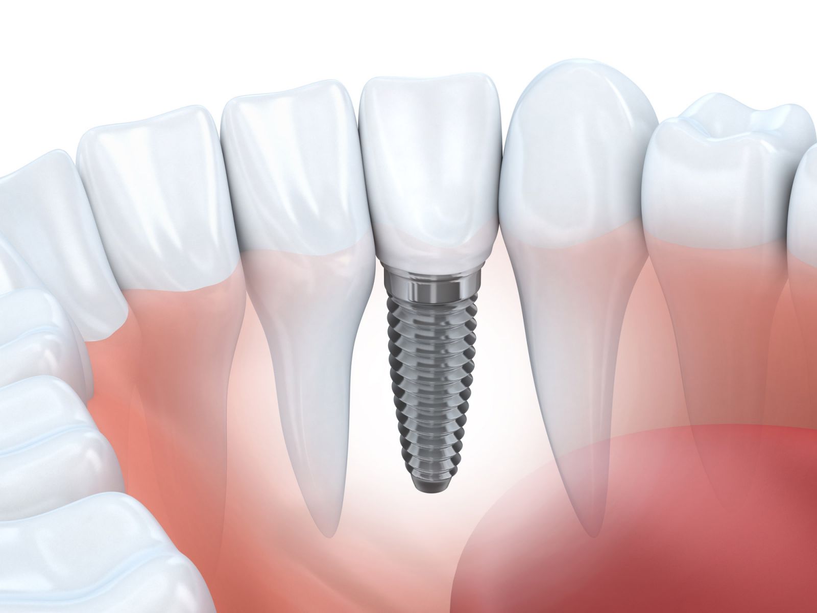 Trồng răng implant có đau không