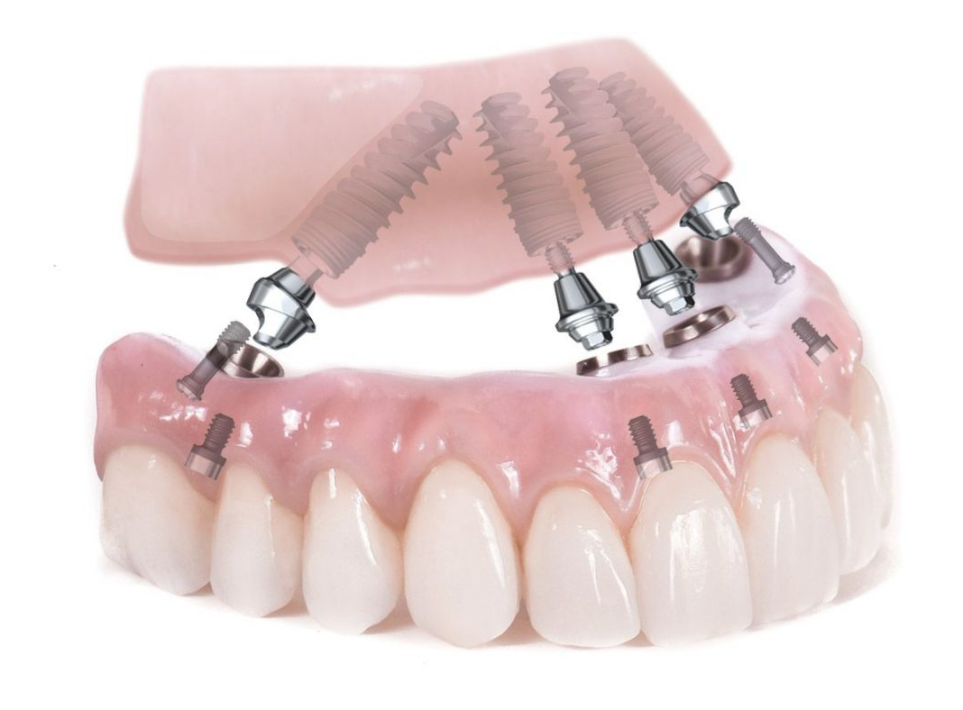 Cấy ghép implant all on 4