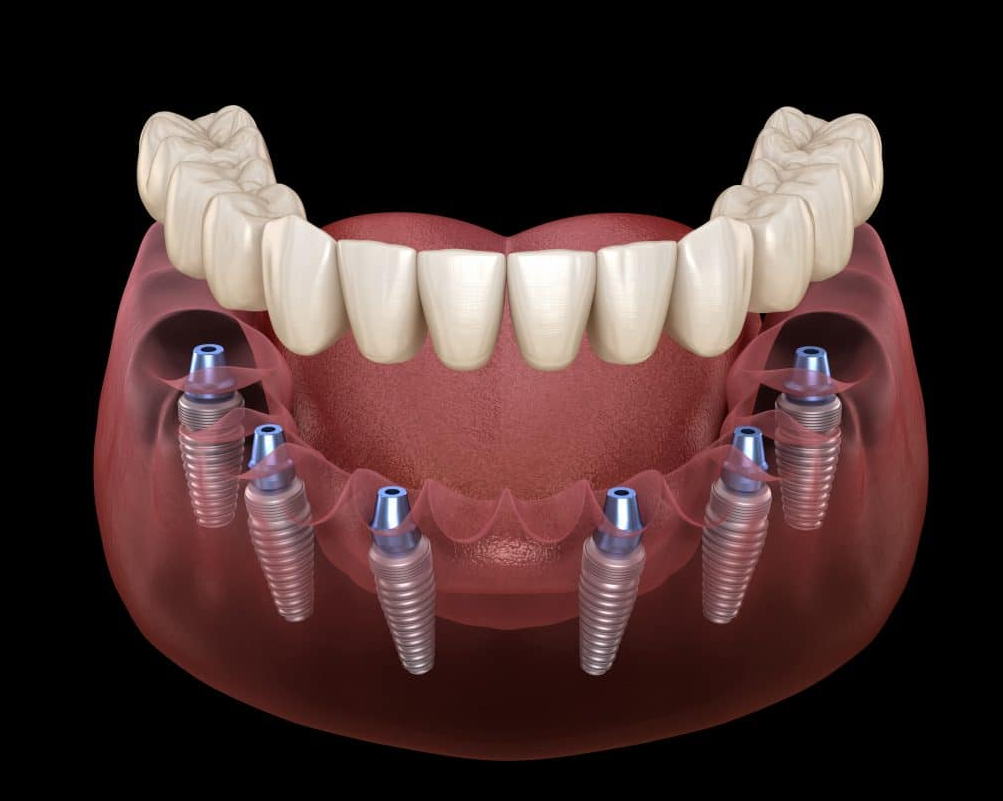 Khái niệm cấy ghép implant all on 6 là gì?