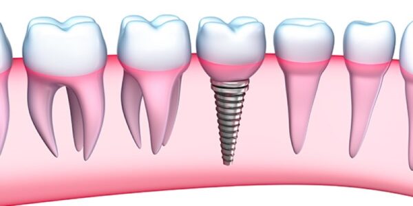 What is the process of getting dental implants overseas? What is the process of getting dental implants overseas?