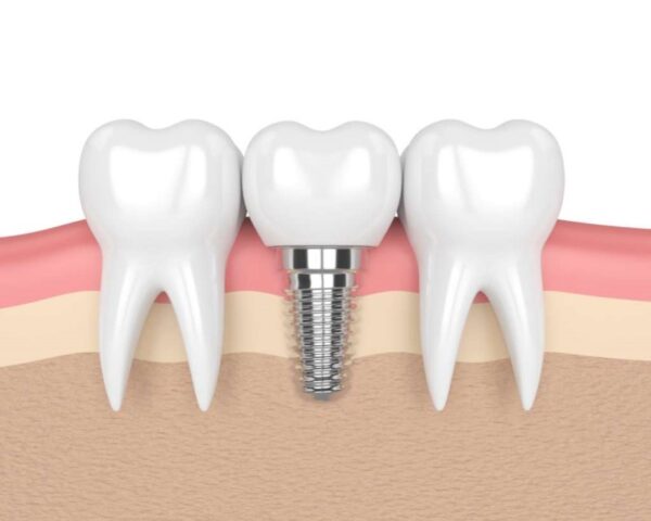 Factors to consider when choosing dental implants overseas Factors to consider when choosing dental implants overseas