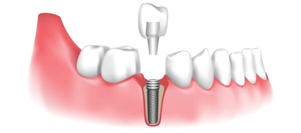 How to remove dental implants? How to remove dental implants?