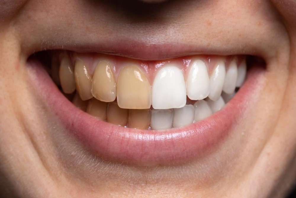 Types of teeth stains