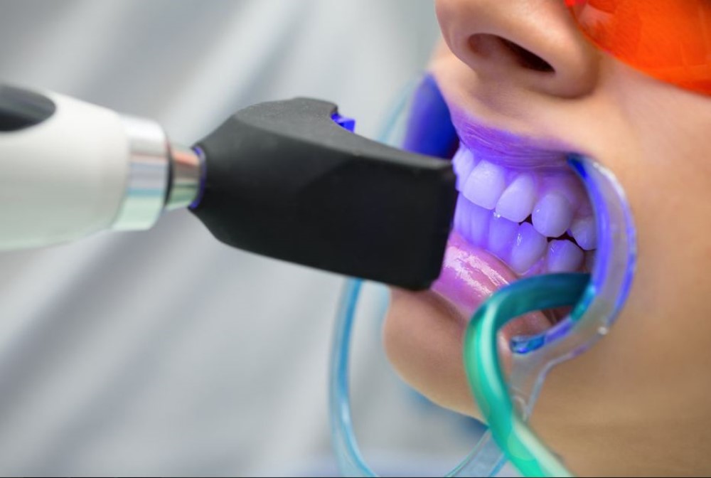 Popular teeth whitening methods