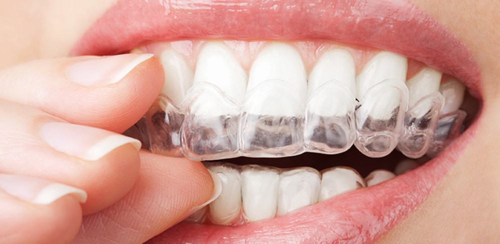 Teeth whitening side effects