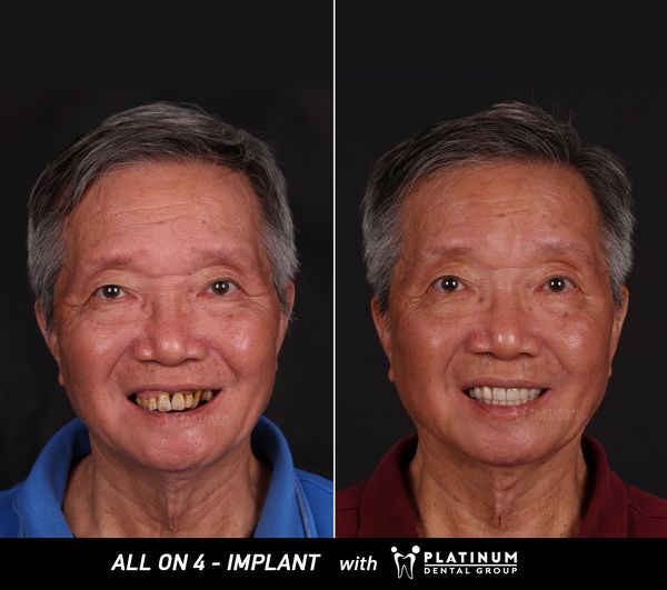 Hình ảnh Khách Hàng trồng răng Implant All On 4 tại Platinum Dental
