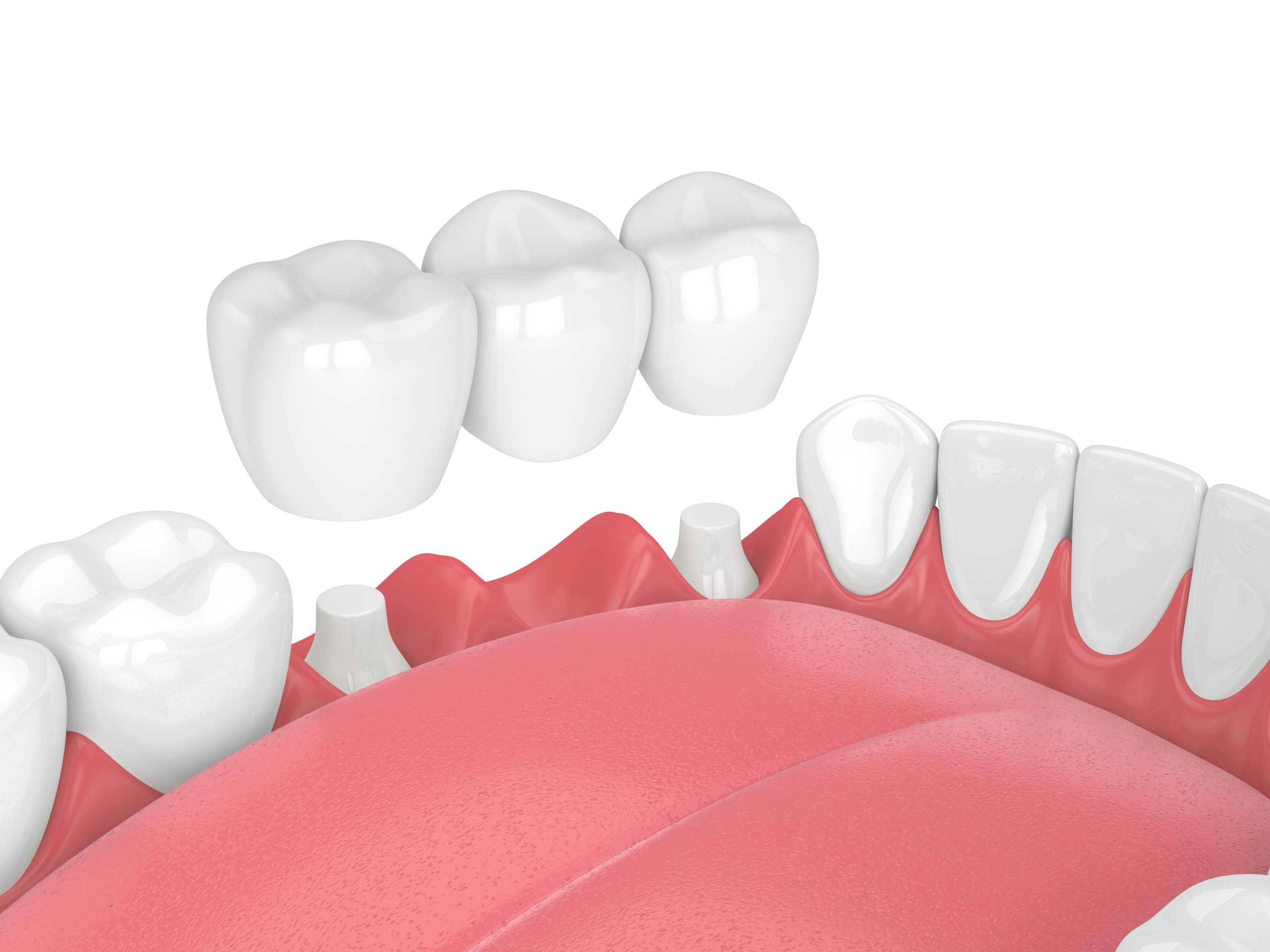 Chi phí trồng răng sứ và implant là bao nhiêu?