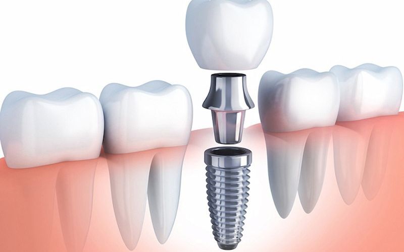 Điểm nổi bật của implant hiossen