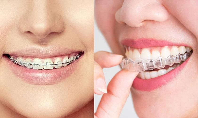 Đôi nét về niềng răng trong suốt và mắc cài