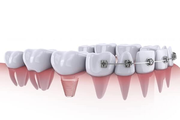 Giải đáp thắc mắc " cấy implant có niềng răng được không?"