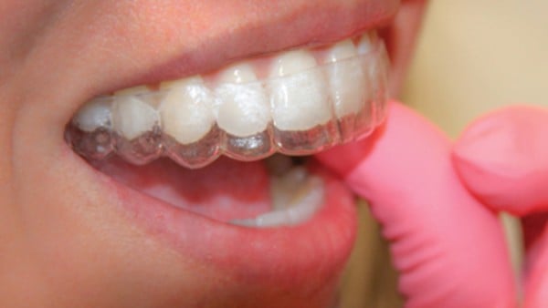 Hàm Duy Trì Vivera - Giữ Nụ Cười Trọn Vẹn