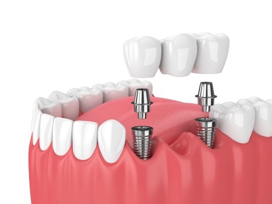 Implant Hiossen Có Tốt Không?