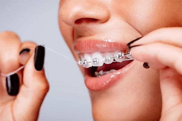 Một số lưu ý cần chú trọng chăm sóc răng implant trước và sau khi niềng