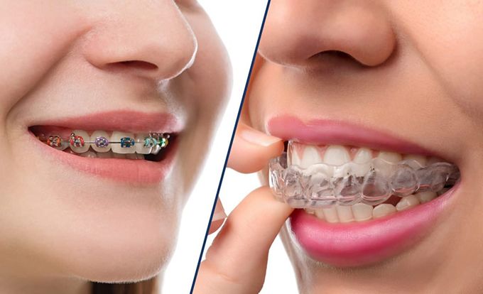 Nên Niềng Răng Trong Suốt Hay Mắc Cài Là Tốt Nhất