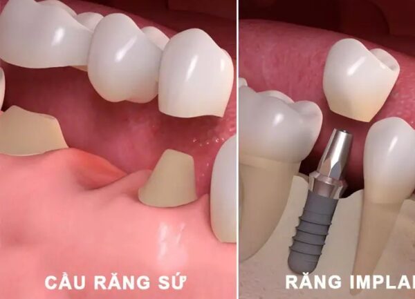 Nên Trồng Răng Sứ Hay Implant? Loại Nào Là Tốt Nhất?
