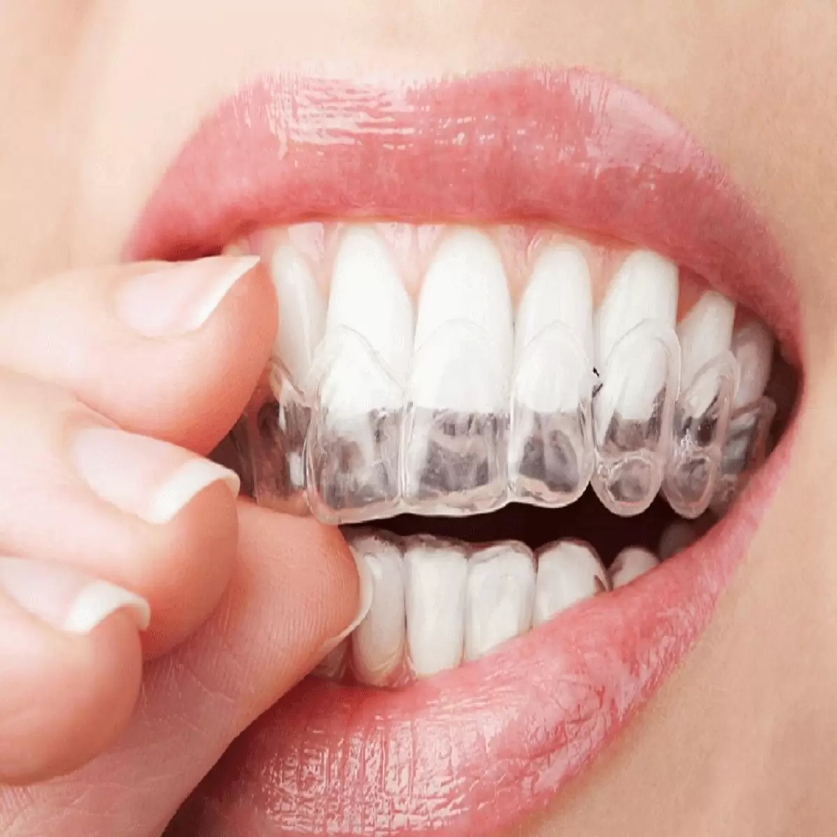 Nguồn gốc, xuất xứ của hai loại niềng răng
