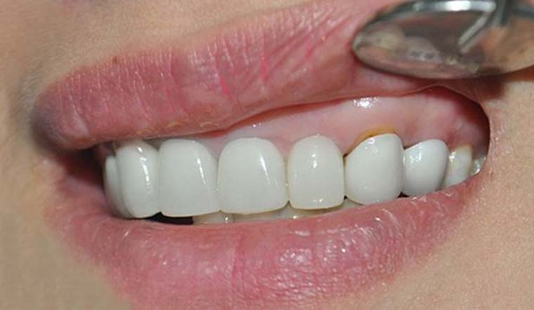 Nguyên Nhân Và Cách Điều Trị Khi Chân Răng Bị Đen