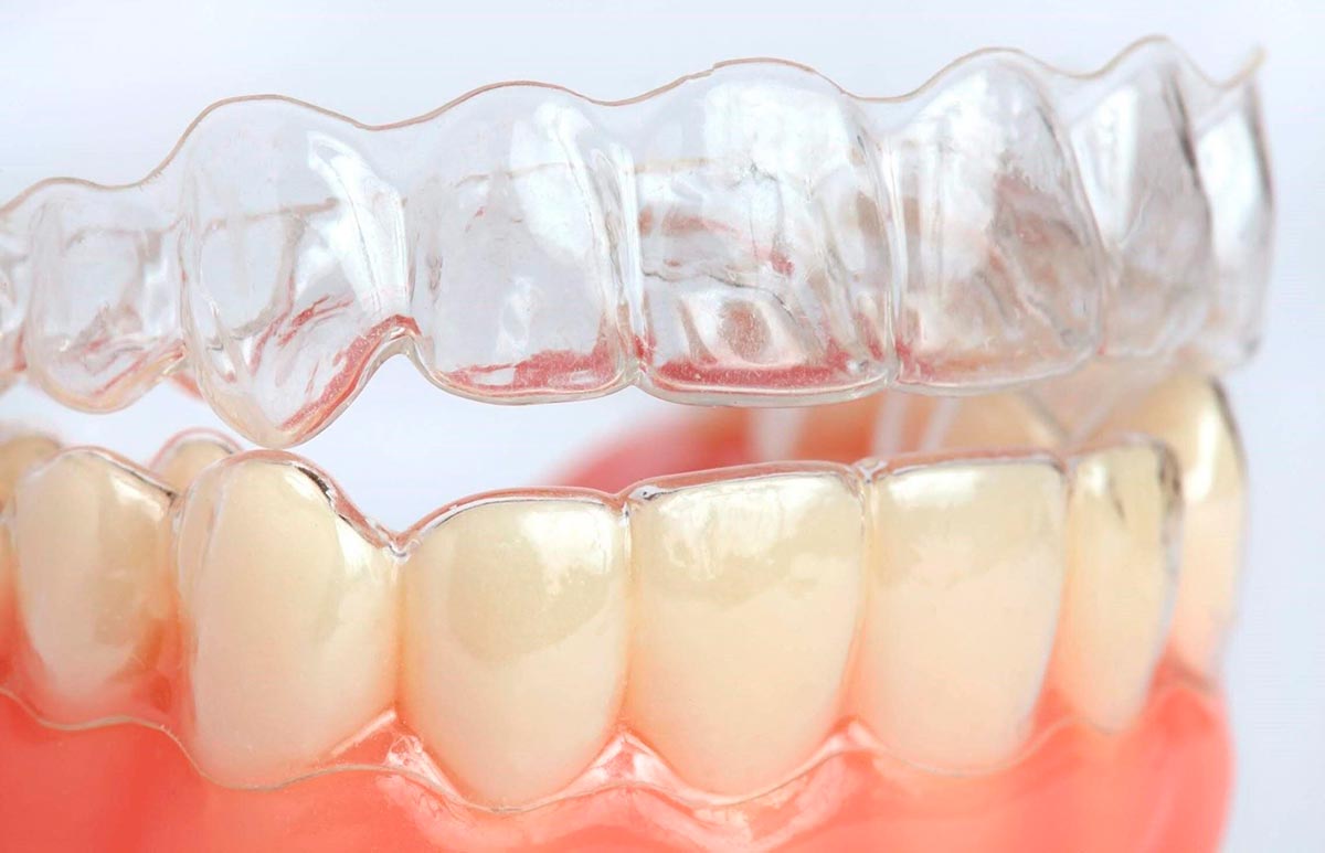 Niềng răng trong suốt là gì?
