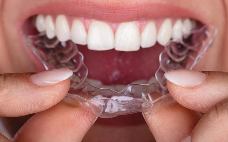 Niềng răng trong suốt ở đâu uy tín?