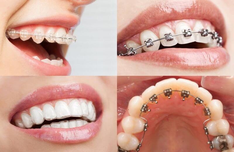 Hướng dẫn chi tiết quy trình niềng răng sau khi cấy implant