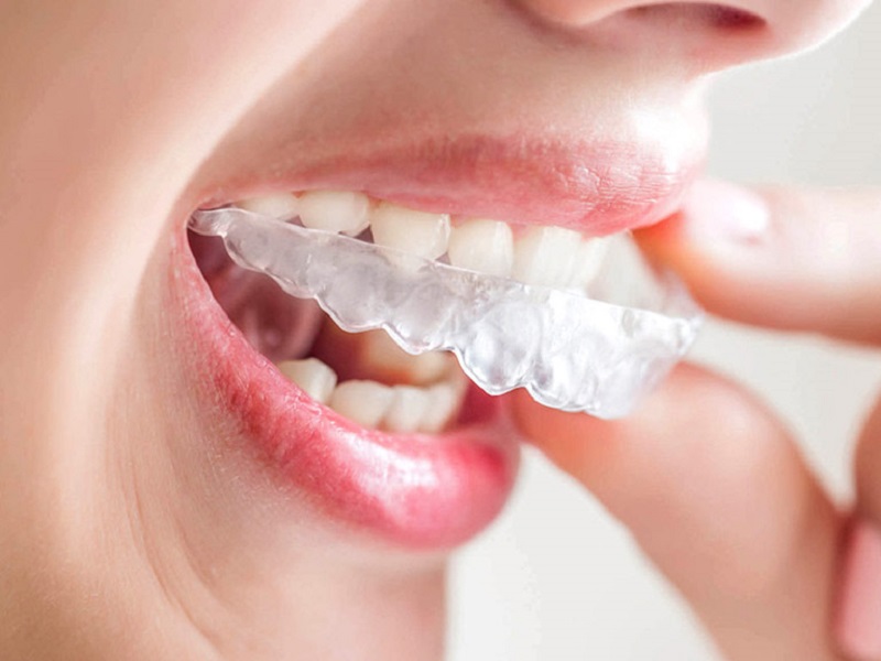 So Sánh Niềng Răng Zenyum Và Invisalign Có Sự Khác Biệt Như Thế Nào?