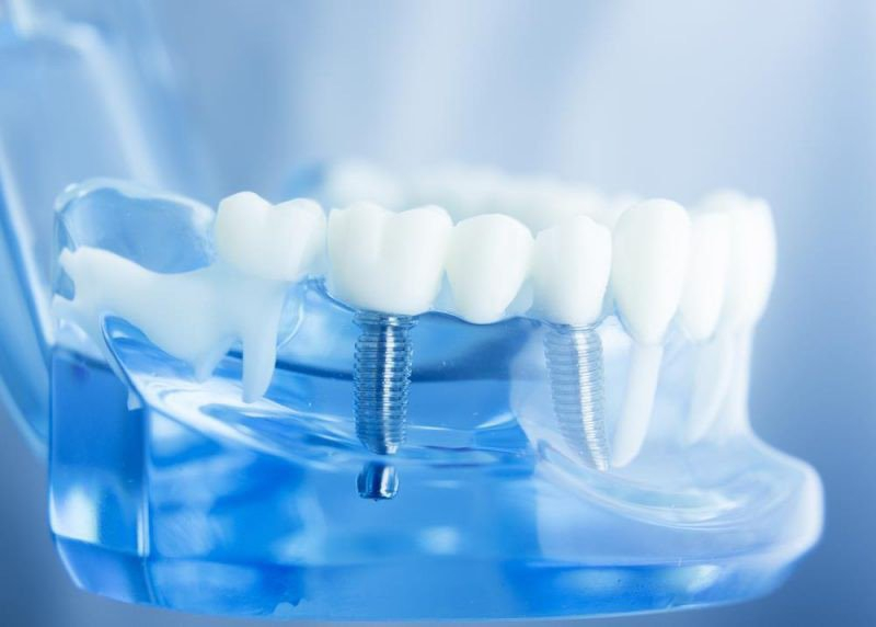 Thời điểm phù hợp nhất để cấy implant hiossen