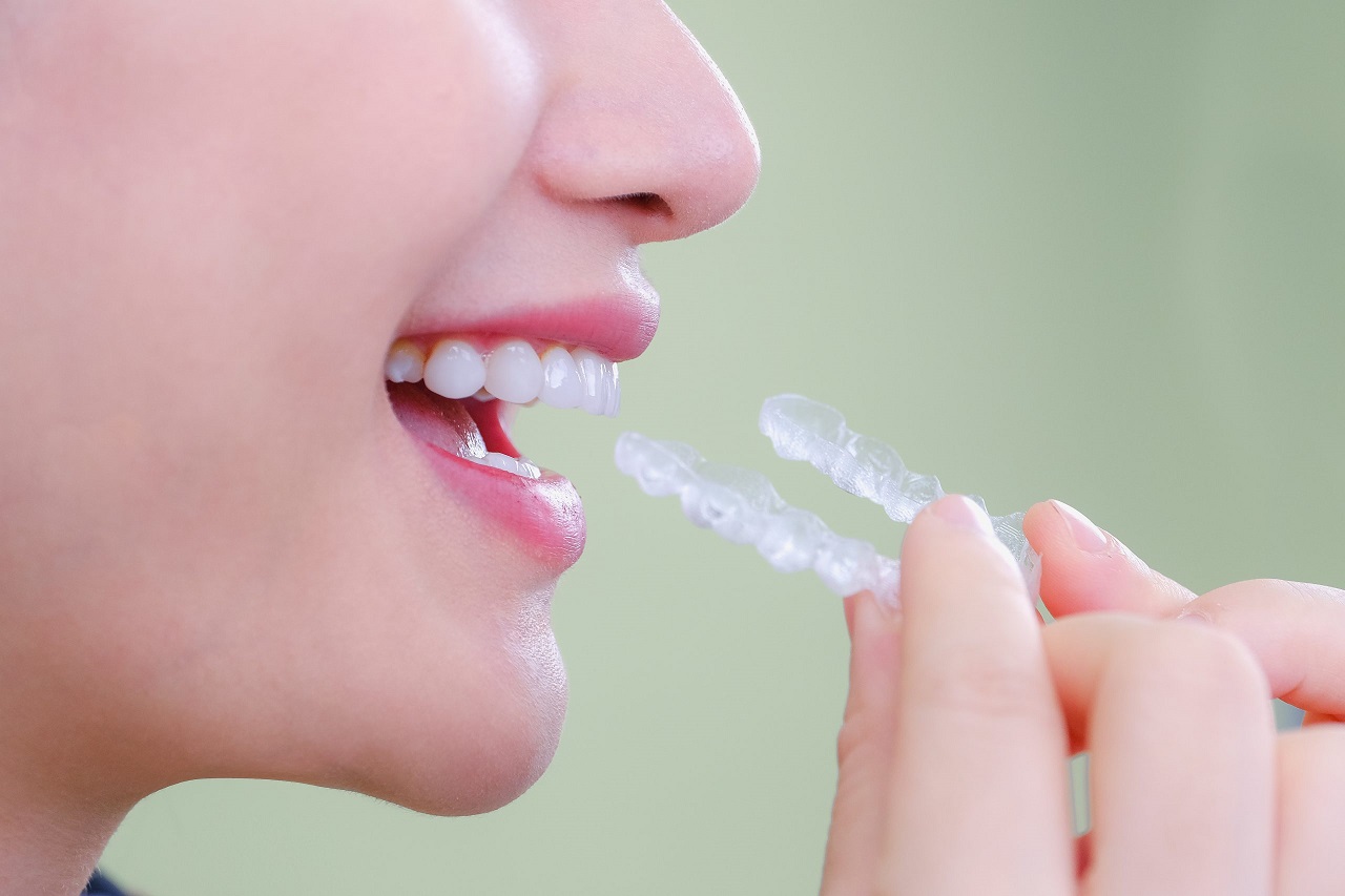 Trong các loại niềng răng trong suốt thì loại nào tốt nhất? Vì sao?