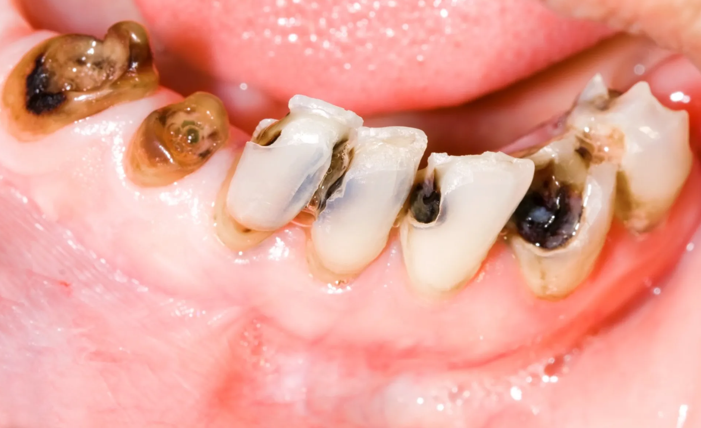 Điều trị chân răng bị đen như thế nào?