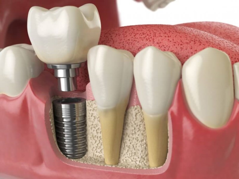 Is Bleeding Normal After Dental Implants?