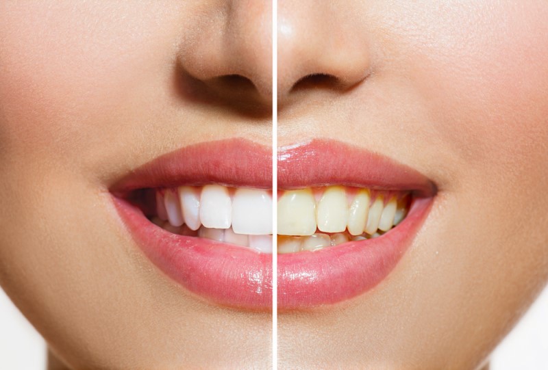 Why are teeth yellow and dull?