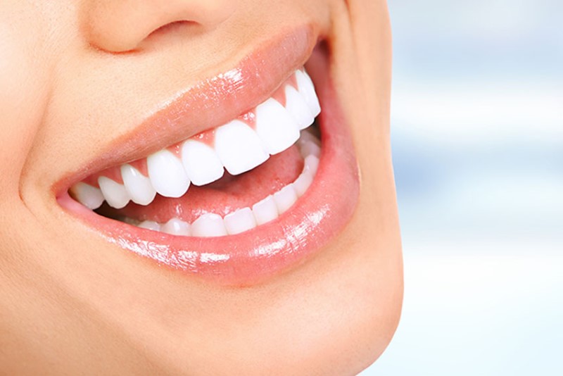 How long does teeth whitening last?