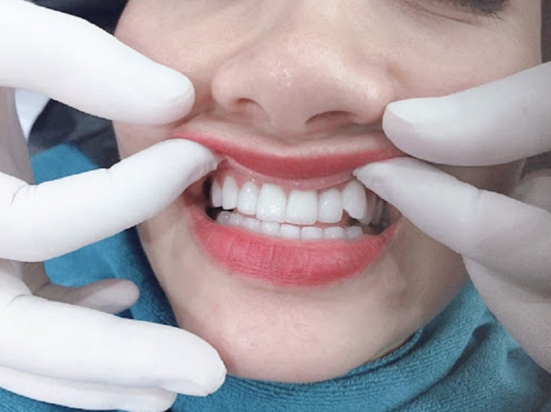 yếu tố ảnh hưởng đến chi phí mài răng