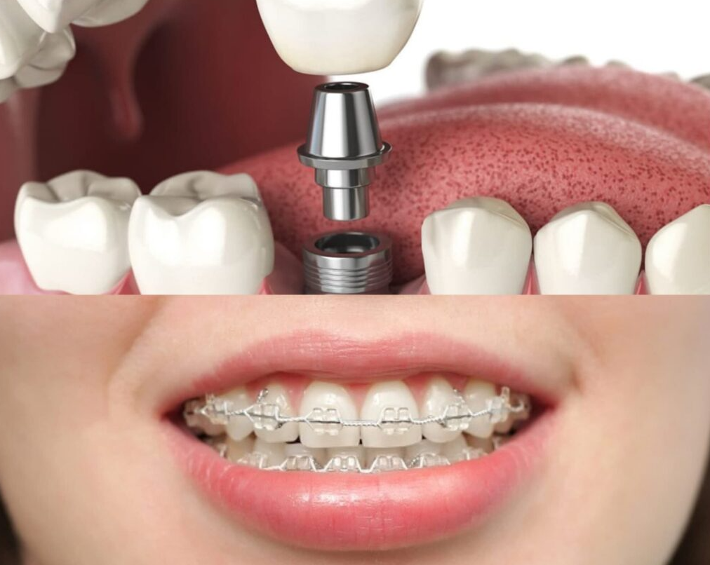 cấy implant có niềng răng được không