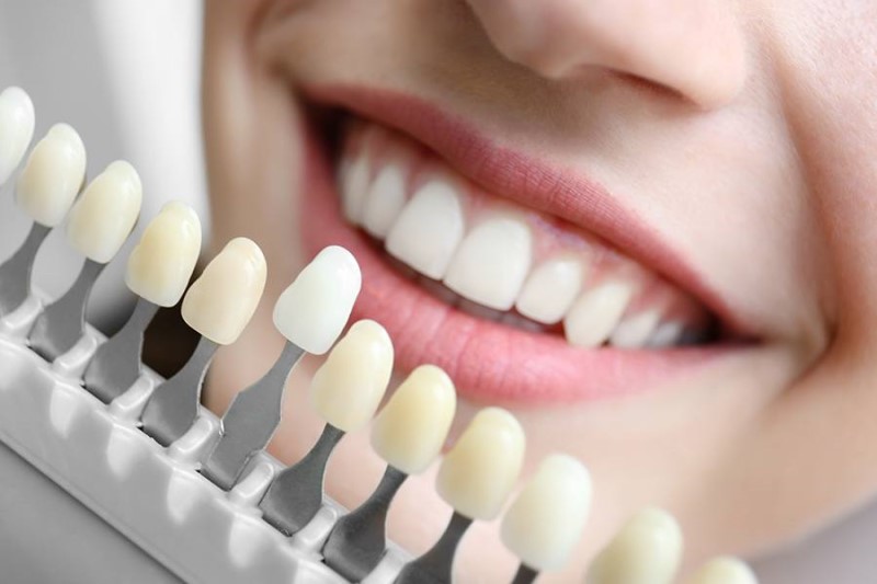 The Different Types Of Teeth Whitening At Dentist?
