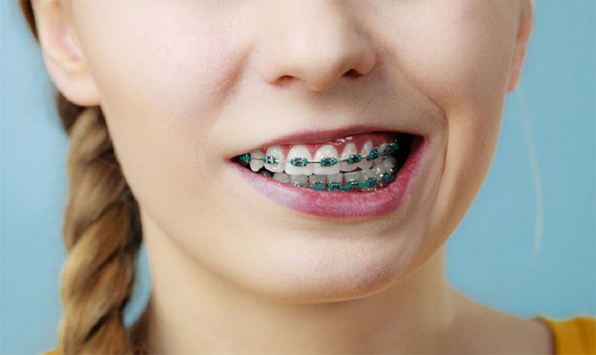 Nguyên Nhân Và Cách Khắc Phục Niềng Răng Bị Lệch Mặt Hiệu Quả