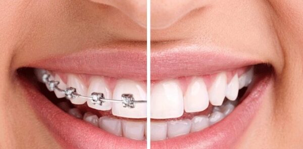 Răng sứ có niềng được không? 