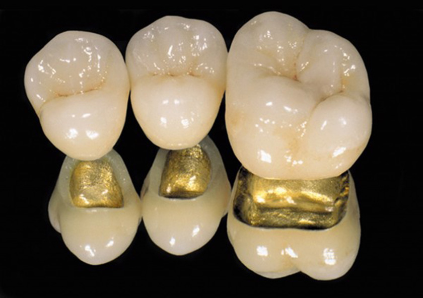 Răng sứ từ kim loại quý