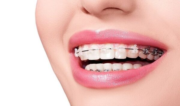 Các yếu tố ảnh hưởng đến thời gian niềng răng