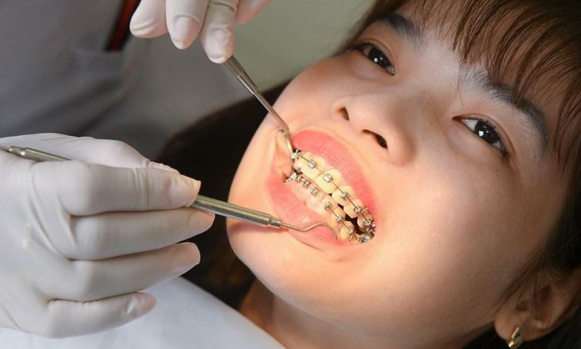 Các yếu tố ảnh hưởng đến thời gian niềng răng