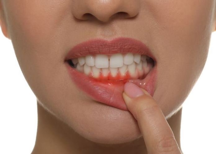 Cảm giác thường gặp sau khi bọc răng sứ