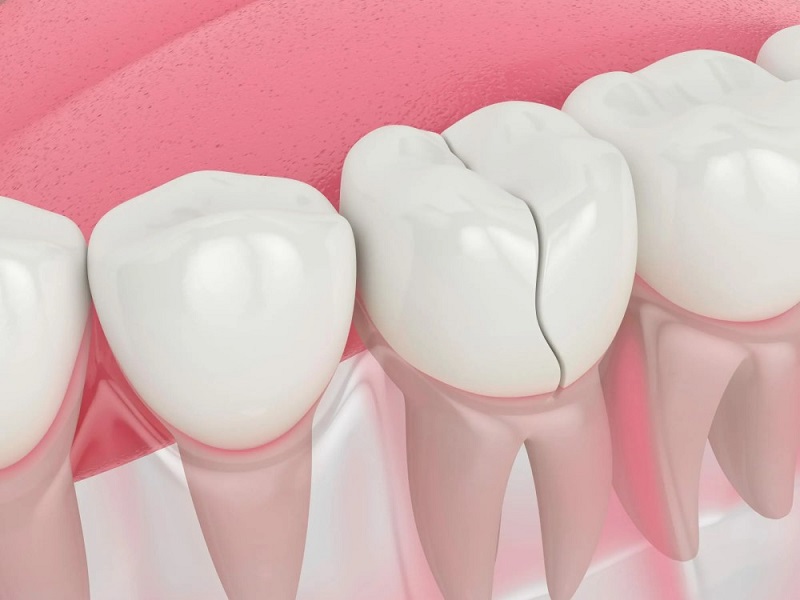 Chipped or broken teeth
